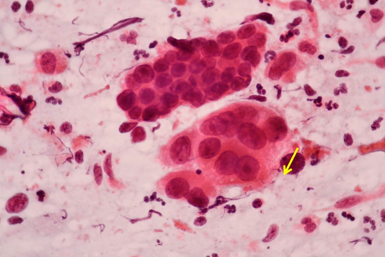 Issues of the Evaluation of Endocervical Cells of the Uterine Cervix on